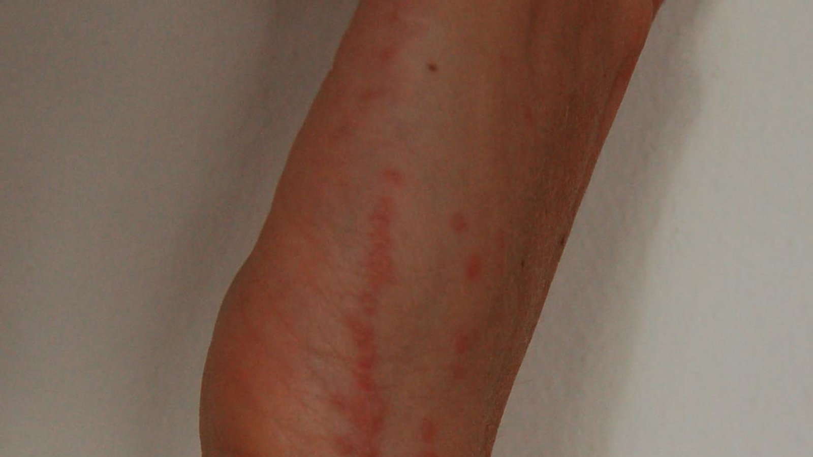 Укуси постільного клопа на зап'ясті: лінія червоних бугорків, характерна «доріжка»
